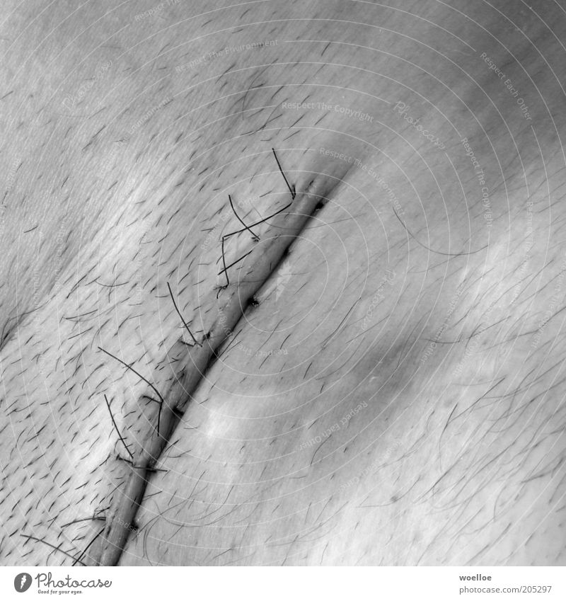 Bauchweh maskulin Mann Erwachsene Haut Leiste Lende Intimbereich Schamhaare Narbe Naht 1 Mensch kaputt Krankheit stachelig Schmerz Heilung Leistenbruch