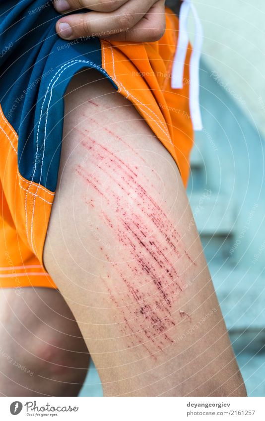 Bruise Wunde am Bein des Kindes Haut Medikament Mensch Junge Kindheit Arme rot weiß Schmerz blaue Flecken Knie zerkratzen Unfall Blut Gesundheit verletzt wehtun