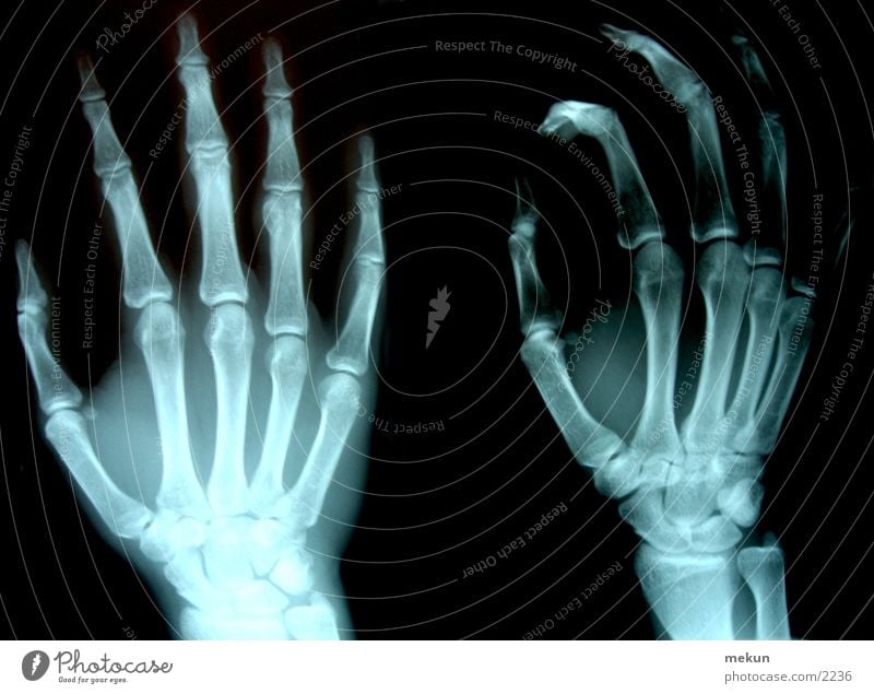 XRay Röntgenstrahlen Hand Arzt Skelett Gesundheitswesen Fototechnik Radiologie