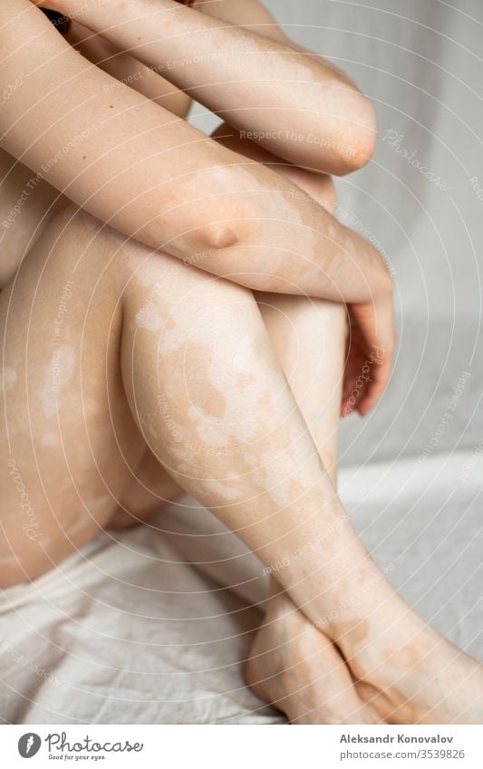 Junge Frau mit bleicher Haut und Vitiligo sitzt auf Stoffhintergrund bei natürlichem Licht in transparenter Unterwäsche Körper Schönheit schlank schön weiß