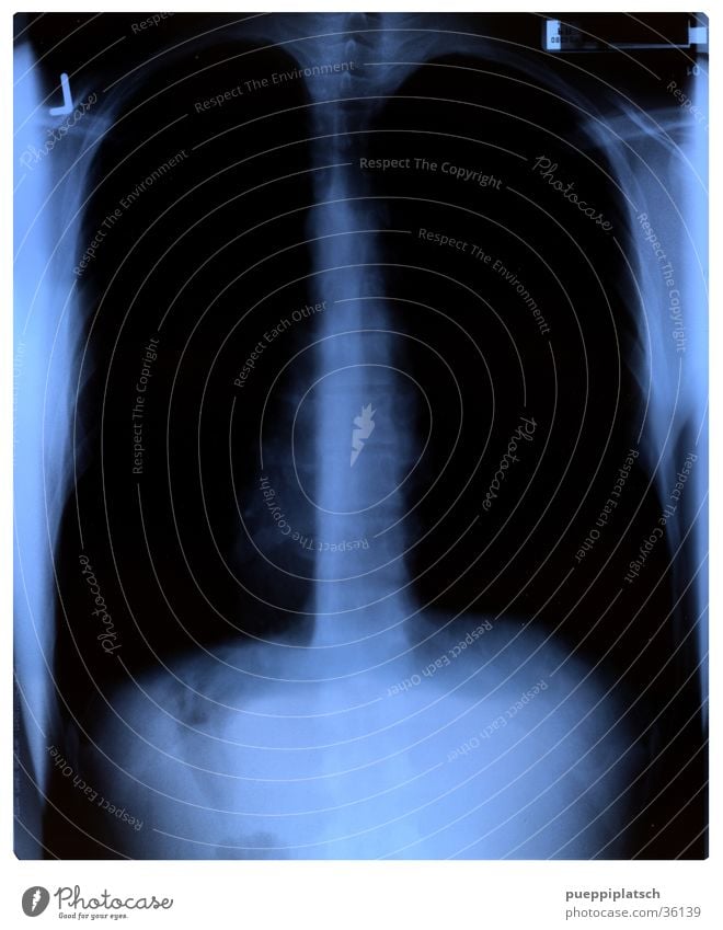 Innenaufnahme Lunge Röntgenbild Wirbelsäule Brustkorb schwarz Mann blau Radiologie