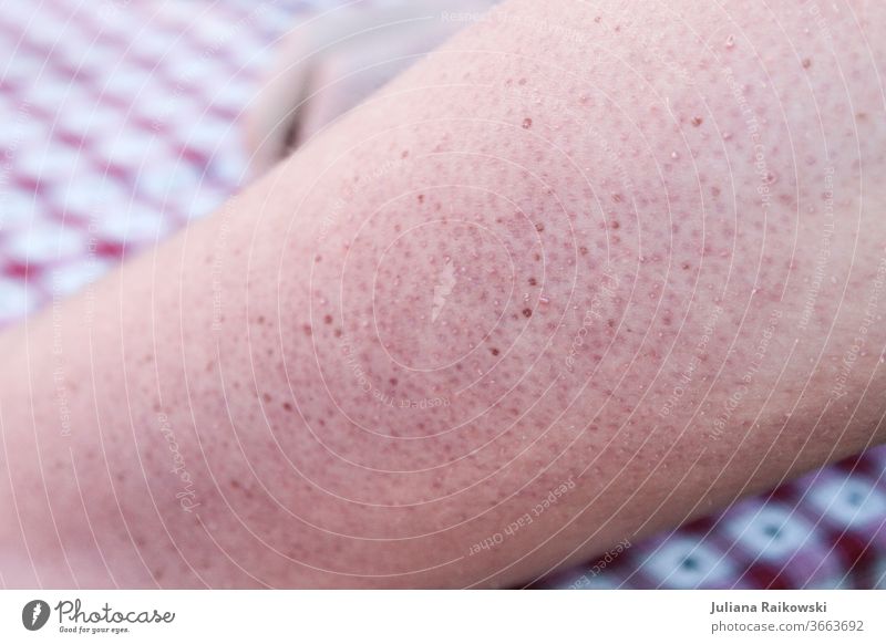 trockene, schuppige Haut, die dringend Creme braucht Mensch Nahaufnahme Detailaufnahme Pickel Hautschuppen Farbfoto Makroaufnahme Schwache Tiefenschärfe