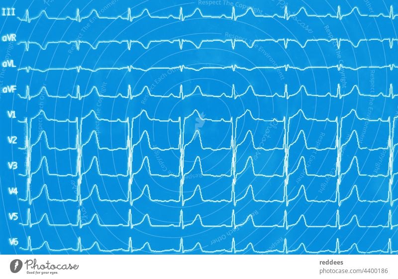 EKG-Anzeige eines Herzfrequenz- oder Pulswellenmessgeräts in einem Krankenhaus Grafische Darstellung Kardiologie Elektrokardiogramm ecg Kardiogramm Pflege