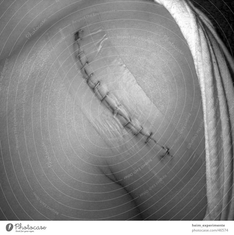1x Narbe - frisch verpackt! Wunde Operation Naht Nähen Schulter Haut Körper
