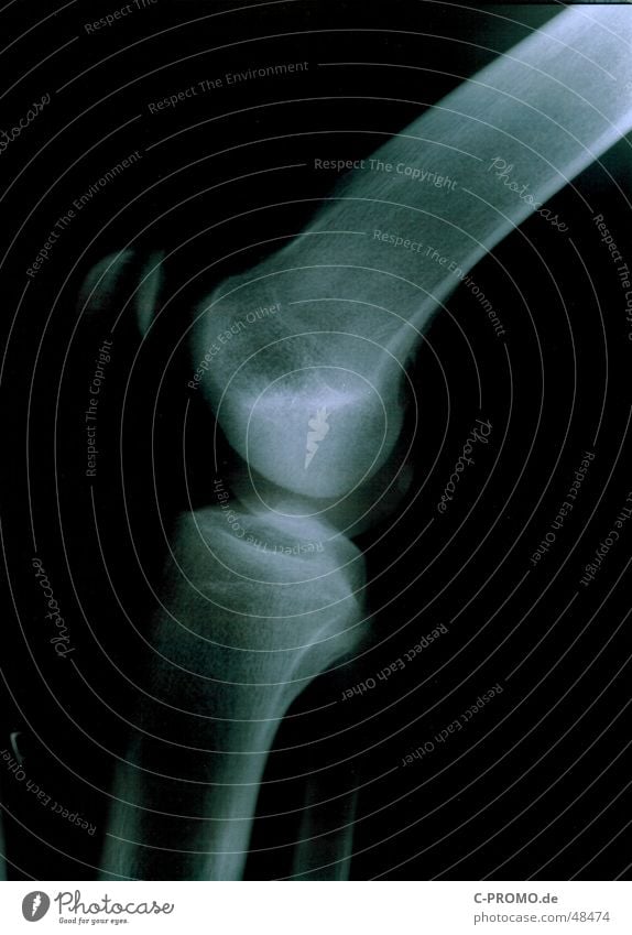 Mein rechtes Knie II :: my right knees II Gesundheitswesen Arzt Gelenk kaputt Kniescheibe Skelett Strahlung schwarz Licht weiß Profil Unterschenkel Oberschenkel