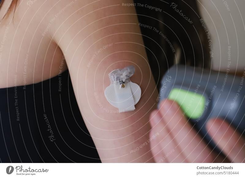 Blutzuckersensor unmittelbar nach dem Einführen mit der Einführhilfe Diabetes Diabetes Typ 1 kontinuierliche Glukoseüberwachung Chronik Krankheit