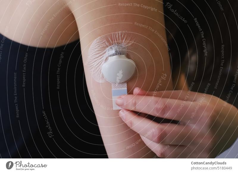 Eingelegter Blutzuckersensor mit Sender und Aufkleber Diabetes Diabetes Typ 1 kontinuierliche Glukoseüberwachung Chronik Krankheit Technik & Technologie cgm