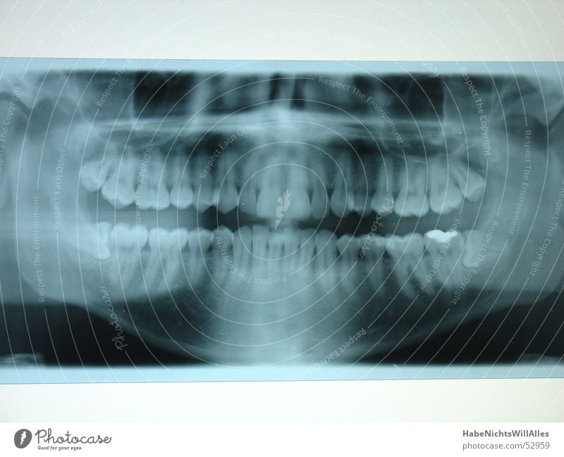 SchieferKiefer? Skelett Leuchtkasten Amalgam Röntgenstrahlen blau Wurzel zahnreihe plombe Mundhöhle Zähne Radiologie