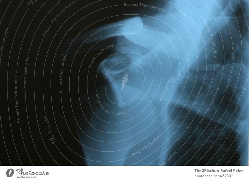 Schulter Luxation rechts schwarz Arzt Bad Rippen Skelett blau valbella Basketball zum 4. mal luxation ausgekugelt Schmerz pain auauauau blue black