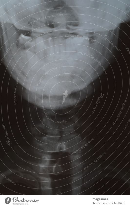 diseased teeth - X-ray of human head and jaw with few teeth. X-ray image of the teeth. Tooth X-ray film, bone loss, patient with removable dentures. Dentist