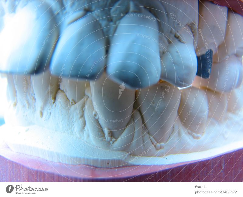 After heavy nightly teeth grinding his teeth had finally gone off the track. Teeth Set of teeth malocclusion Model dental impression Dentist