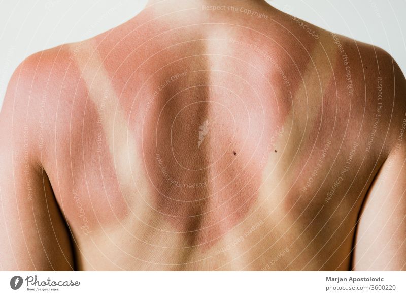 Close-up of a sunburn marks on a woman's back detail outline traces people isolated ultraviolet sunlight tanning beauty natural red health care skin shoulders