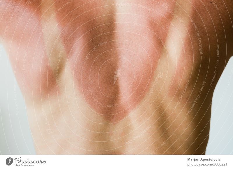 Close-up of a sunburn marks on a woman's back detail outline traces people isolated ultraviolet sunlight tanning beauty natural red health care skin shoulders