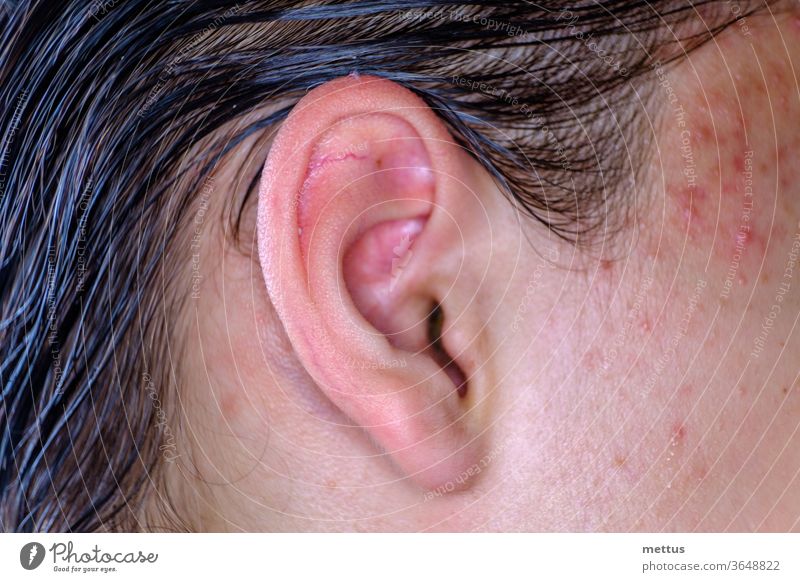 Acne on the skin of the face near the ear macro image. Male skin of the face with inflammations. Teenage Boy's ear human complexion guy anatomy attention eye