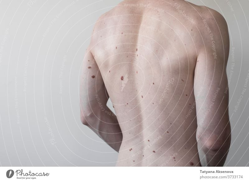 Male torso with a lot of moles, body health birthmark back dermatology skin medical melanoma care dermatologist spot disease naked human person brown adult