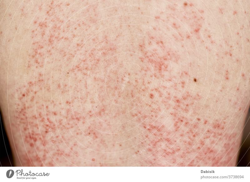 Allergic rash on skin. Woman with dermatology problem on back skin allergy eczema infection disease health medical body red dermatitis epidermis closeup