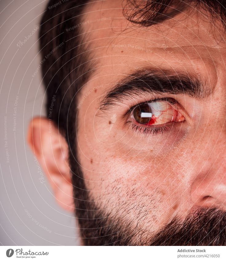 Man with bloodshot eye looking away man red vein inflame irritate infection sick injury male sore unhealthy problem symptom illness suffer unwell disease pain