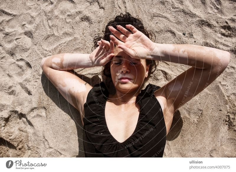 Woman with vitiligo pigment spot disease lies in the sand in bathing suit swimwear and protects herself from the sun with her hands skincare hides cover