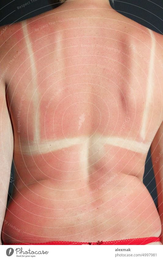 Back burnt after sunburn scald back body skin red pink cancer summer allergy cancerous care caucasian damage dangerous female girl health hot hurt pain fried