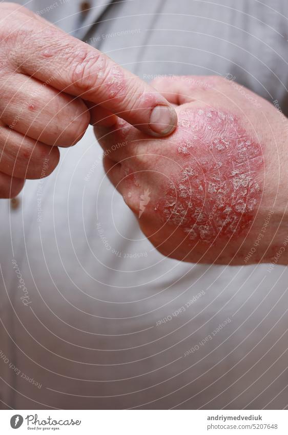 Close up of male showing hands with cracked, hard, horny, flaky skin. Dermatological problems of psoriasis, allergy, eczema. Hand stains, rash, dry skin. The concept of chronic disease treatment.