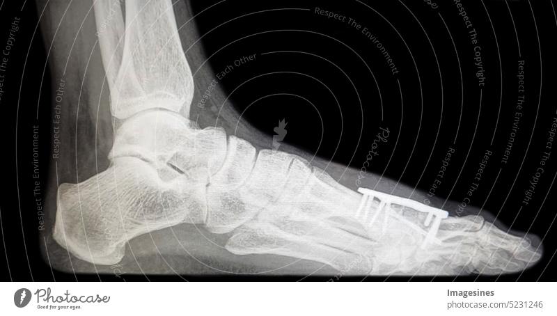 X-ray of bone chip distraction arthrodesis - MTP1 of the metatarsophalangeal joint of the big toe after resection arthroplasty. Inserted bone chip with plate. Female foot after surgery - standing position with minimal load, pressure.