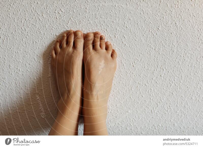 Female feet with subungual hematoma, black toenails caused by trauma, fungal infection, chemotherapy. Person suffering from onychomycosis, fungal infection causing yellowing of the toenail. copy space