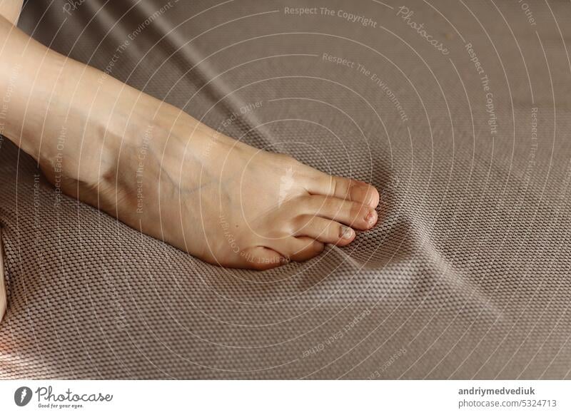 Person feet with subungual hematoma, black toenails caused by trauma, fungal infection or chemotherapy . Female suffering from onychomycosis, a fungal infection causing yellowing of the toenail.