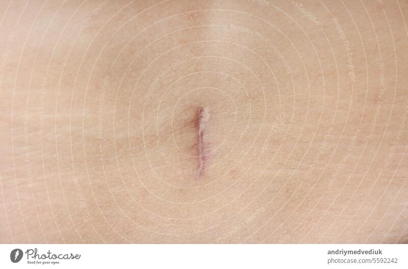 close up of careful scar after surgery on the body. skin medical health medicine operation appendicitis closeup human pain treatment belly wound abdomen