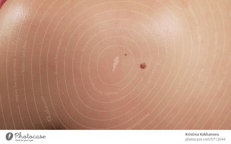 Human papillomavirus. Female back covered with nevuses. Birthmark of Papiloma acrochordon background benign blemish body brown carcinoma care cell close