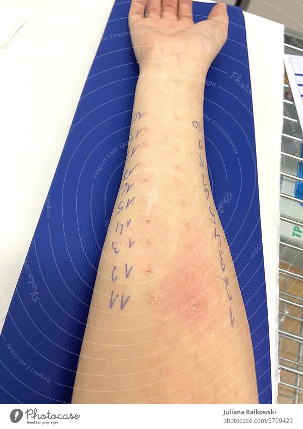 Allergy test for pollen at the dermatologist Pollen Pollination Spring Detail Test result Blossoming Plant Environment Harmful to health Healthy Colour photo