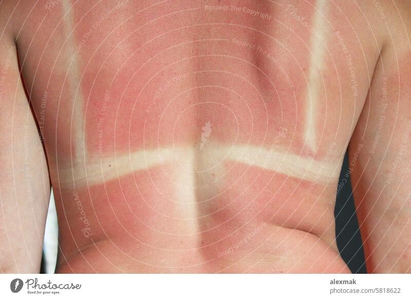 Back burnt after sunburn scald back body skin red pink cancer summer allergy cancerous care caucasian damage dangerous female girl health hot hurt pain fried