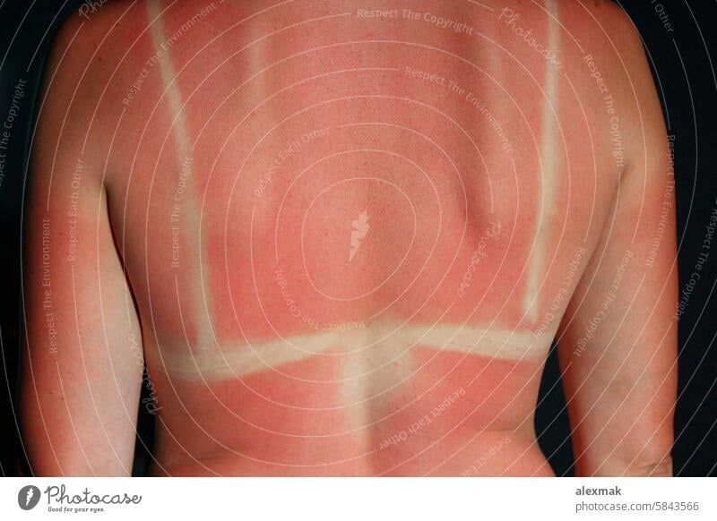 Burn from the sun on the body sunburn skin red pink cancer summer allergy back burnt cancerous care caucasian damage dangerous female girl health hot hurt pain