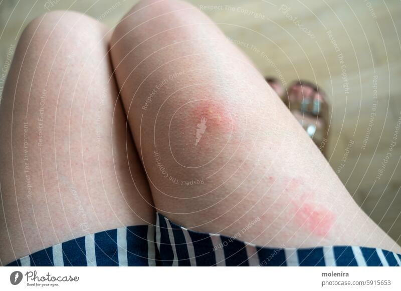 Legs with two large, red mosquito bites legs inflamed swelling itching skin discomfort insects shorts summer close-up reaction nuisance irritation