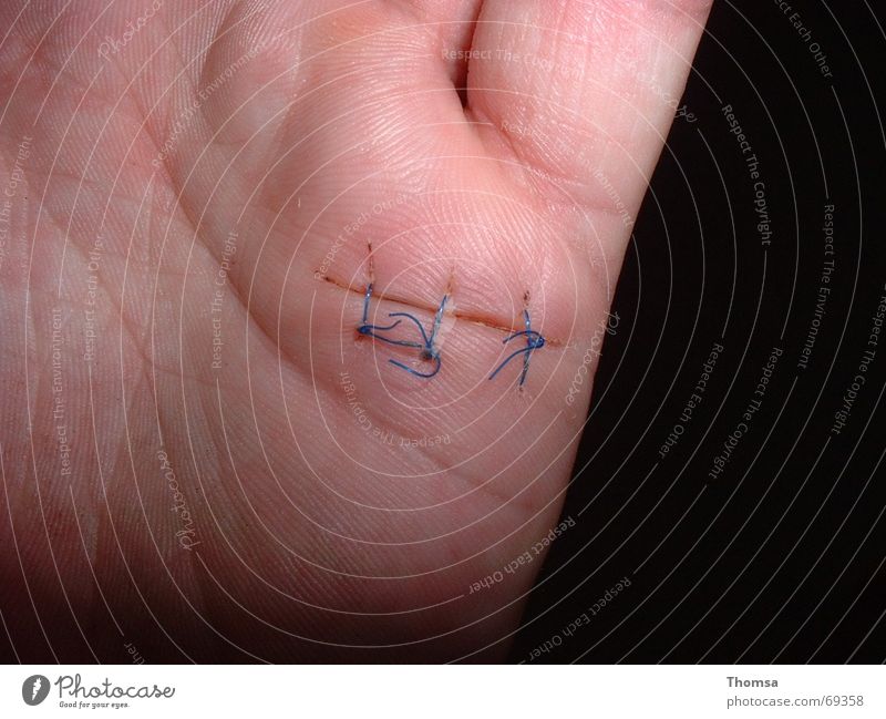 sewn scar on the hand Hand Wound Stitching Palm of the hand Parts of body Scar sewn wound sutured